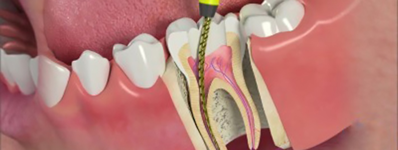 Root Canal Therapy - Thornhedge Dental