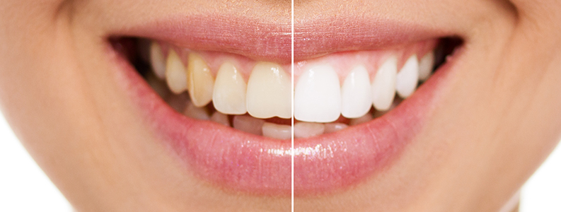 Teeth Whitening - Thornhedge Dental