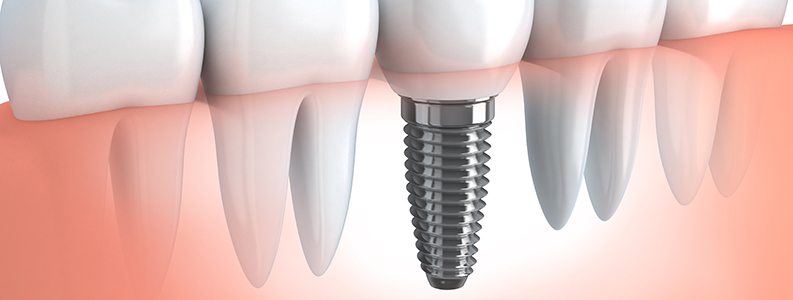 Dental Implants - Thornhedge Dental