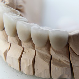 Crowns and Bridges - Thornhedge Dental